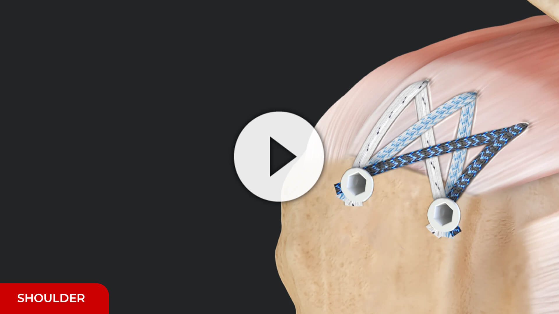 Arthrex - Compression SpeedBridge™ Rotator Cuff Repair